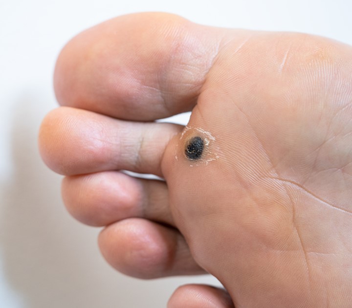 Plantar warts in Children What You Need to Know